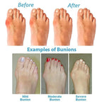 Rosa - Women's Orthopedic Bunion Corrector Sandals
